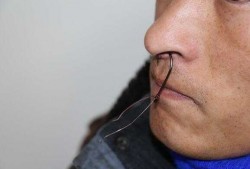 鼻子焊接手术的坏处-做了鼻子焊接手术会怎么样